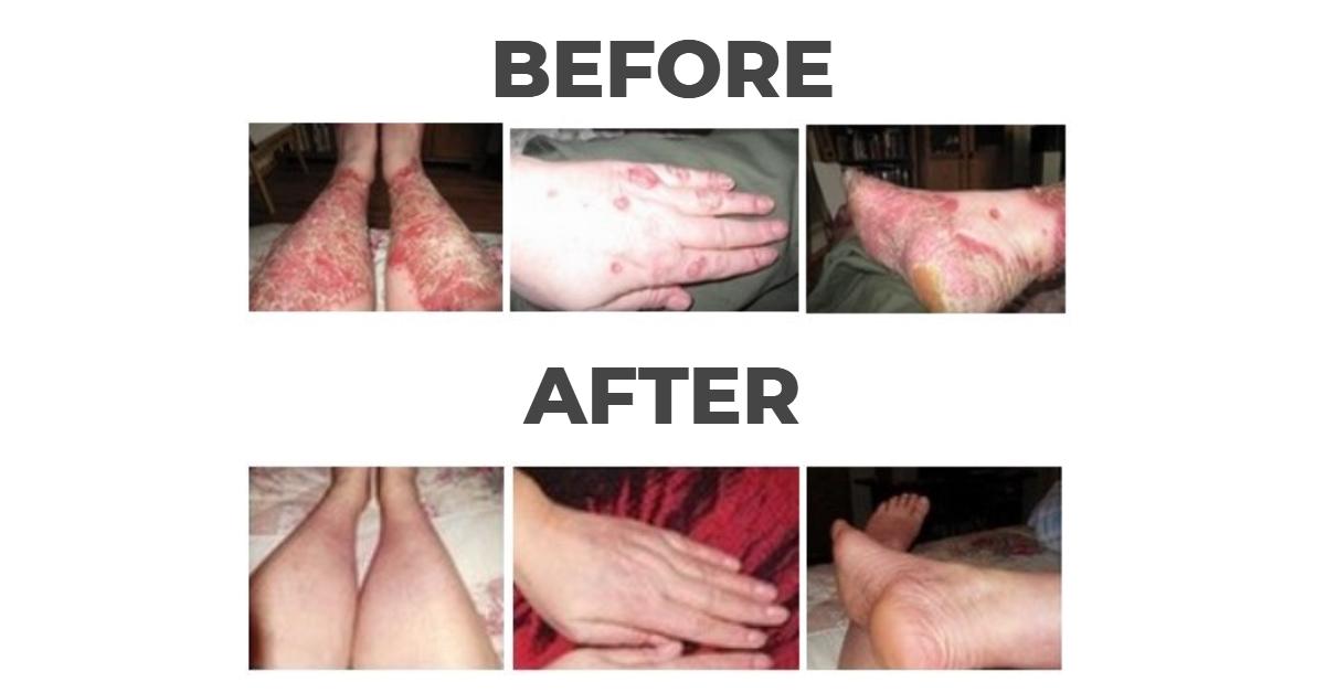 psoriasis before and after